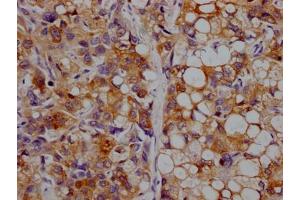 IHC image of ABIN7127343 diluted at 1:100 and staining in paraffin-embedded human liver cancer performed on a Leica BondTM system. (Recombinant APOC3 antibody)