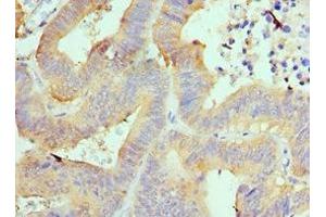 Immunohistochemistry of paraffin-embedded human colon cancer using ABIN7143994 at dilution of 1:100 (AIMP1 antibody  (AA 25-180))