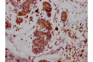 IHC image of ABIN7127832 diluted at 1:100 and staining in paraffin-embedded human breast cancer performed on a Leica BondTM system. (Recombinant SUZ12 antibody)