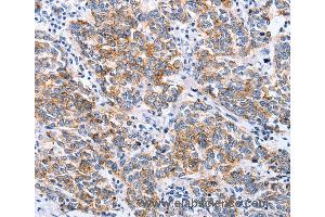 Immunohistochemistry of Human breast cancer using CLDN3 Polyclonal Antibody at dilution of 1:25 (Claudin 3 antibody)