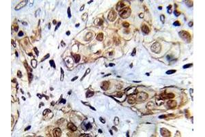 Immunohistochemistry analyzes of Abl1 antibody in paraffin-embedded human breast carcinoma tissue. (ABL1 antibody)
