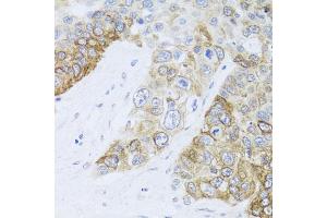 Immunohistochemistry of paraffin-embedded human lung cancer using CHD1 antibody. (CHD1 antibody)