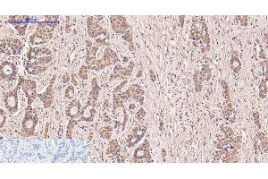 Immunohistochemistry of paraffin-embedded Human liver cancer tissue using CD5 Monoclonal Antibody at dilution of 1:200. (CD5 antibody)