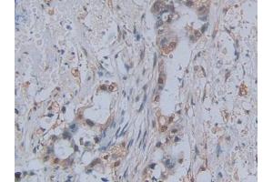 DAB staining on IHC-P; Samples: Human Pancreatic cancer Tissue (CCL2 antibody  (AA 24-99))