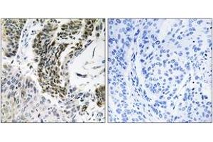 Immunohistochemistry analysis of paraffin-embedded human lung carcinoma tissue, using RREB1 Antibody. (RREB1 antibody  (AA 560-609))