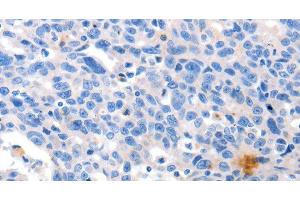 Immunohistochemistry of paraffin-embedded Human ovarian cancer tissue using GRIN2D Polyclonal Antibody at dilution 1:30 (GRIN2D antibody)