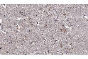 ABIN6276561 at 1/100 staining Human brain cancer tissue by IHC-P. (BCL2L2 antibody  (N-Term))