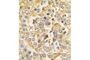 Formalin-fixed and raffin-embedded human breast carcinoma tissue reacted with Natriuretic Peptide Receptor A (NPR1/AN) antibody (N-term) (ABIN392702 and ABIN2842183) , which was peroxidase-conjugated to the secondary antibody, followed by DAB staining. (NPR1 antibody  (N-Term))