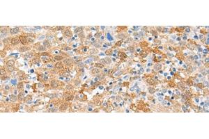 Immunohistochemistry of paraffin-embedded Human cervical cancer tissue using FANCB Polyclonal Antibody at dilution of 1:60(x200) (FANCB antibody)