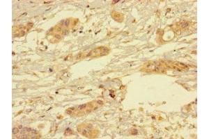 Immunohistochemistry of paraffin-embedded human pancreatic cancer using ABIN7166350 at dilution of 1:100 (YIPF6 antibody  (AA 2-84))