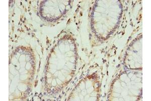 Immunohistochemistry of paraffin-embedded human colon cancer using ABIN7142648 at dilution of 1:100