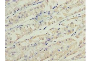 Immunohistochemistry of paraffin-embedded human gastric cancer using ABIN7173199 at dilution of 1:100 (TMEM31 antibody  (AA 1-118))