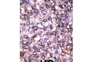 Formalin-fixed and paraffin-embedded human cancer tissue reacted with the primary antibody, which was peroxidase-conjugated to the secondary antibody, followed by AEC staining. (MAGED2 antibody  (C-Term))