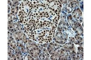 Immunohistochemical staining of paraffin-embedded Adenocarcinoma of colon tissue using anti-RC211175 mouse monoclonal antibody. (TUBA8 antibody)