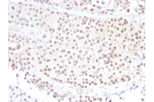 Formalin-fixed, paraffin-embedded human Bladder Carcinoma stained with p21 Mouse Monoclonal Antibody (DCS-60. (p21 antibody)