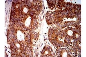 Immunohistochemical analysis of paraffin-embedded rectum cancer tissues using EIF5 mouse mAb with DAB staining. (EIF5 antibody  (AA 1-300))