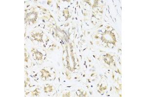 Immunohistochemistry of paraffin-embedded human mammary cancer using STAT1 antibody. (STAT1 antibody  (AA 650-750))