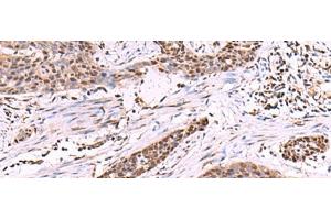 Immunohistochemistry of paraffin-embedded Human esophagus cancer tissue using CUL4A Polyclonal Antibody at dilution of 1:55(x200) (Cullin 4A antibody)