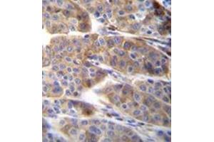 Immunohistochemistry analysis in formalin fixed and paraffin embedded human melanoma reacted with PLA2G2C Antibody (C-term) followed which was peroxidase conjugated to the secondary antibody and followed by DAB staining.
