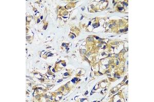 Immunohistochemistry of paraffin-embedded human breast cancer using CCDC124 antibody  at dilution of 1:100 (40x lens). (CCDC124 antibody  (AA 1-223))