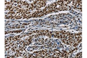 The image on the left is immunohistochemistry of paraffin-embedded Human gastic cancer tissue using ABIN7190953(HIST1H2AB Antibody) at dilution 1/20, on the right is treated with synthetic peptide. (HIST1H2AB antibody)