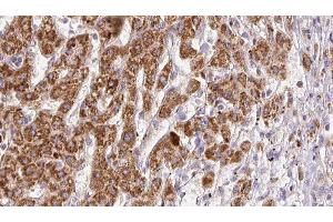 ABIN6278185 at 1/100 staining Human liver cancer tissue by IHC-P. (PNPLA2 antibody  (Internal Region))