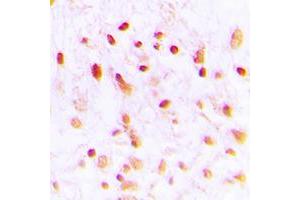 Immunohistochemical analysis of CTBP1 staining in human lung cancer formalin fixed paraffin embedded tissue section. (CTBP1 antibody  (C-Term))