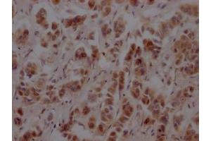 IHC image of ABIN7127649 diluted at 1:100 and staining in paraffin-embedded human breast cancer performed on a Leica BondTM system.