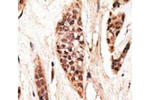 IHC analysis of FFPE human breast carcinoma tissue stained with the TAP1 antibody (TAP1 antibody  (AA 765-794))