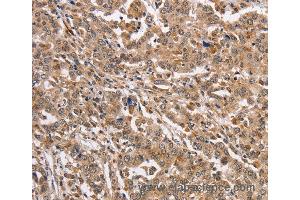 Immunohistochemistry of Human liver cancer using KCNG2 Polyclonal Antibody at dilution of 1:40