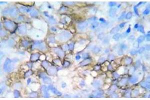 Immunohistochemistry (IHC) analyzes of p-HSP27 antibody in paraffin-embedded human breast carcinoma tissue. (HSP27 antibody  (pSer78, pSer82))