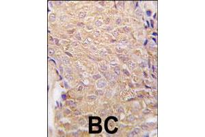 Formalin-fixed and paraffin-embedded human breast carcinoma tissue reacted with ALDH6A1 polyclonal antibody  , which was peroxidase-conjugated to the secondary antibody, followed by DAB staining.
