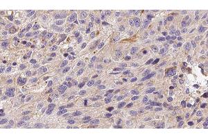 ABIN6279085 at 1/100 staining Human melanoma tissue by IHC-P. (ADAMTS13 antibody  (C-Term))
