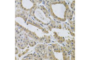 Immunohistochemistry of paraffin-embedded human thyroid cancer using NCF4 Antibody (ABIN5971122) at dilution of 1/100 (40x lens). (NCF4 antibody)