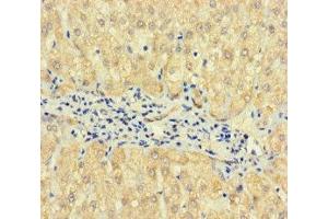 Immunohistochemistry of paraffin-embedded human liver cancer using ABIN7163173 at dilution of 1:100 (TPTE2 antibody  (AA 167-411))