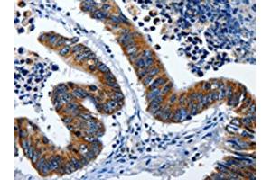 The image on the left is immunohistochemistry of paraffin-embedded Human colon cancer tissue using ABIN7191255(LAMA1 Antibody) at dilution 1/25, on the right is treated with synthetic peptide. (Laminin alpha 1 antibody)