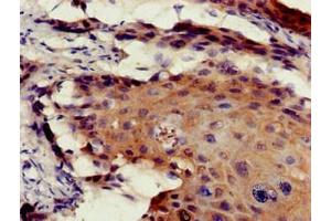 Immunohistochemistry of paraffin-embedded human cervical cancer using ABIN7172545 at dilution of 1:100 (ETV7 antibody  (AA 134-218))