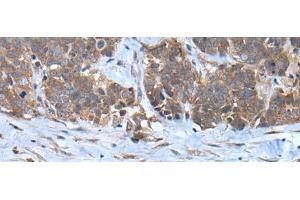 Immunohistochemistry of paraffin-embedded Human thyroid cancer tissue using CNTN1 Polyclonal Antibody at dilution of 1:35(x200) (Contactin 1 antibody)