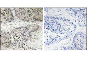 Immunohistochemistry analysis of paraffin-embedded human lung carcinoma, using MAPK15 Antibody. (MAPK15 antibody  (AA 361-410))