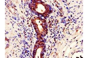 Immunohistochemistry of paraffin-embedded human prostate cancer using ABIN7150628 at dilution of 1:100 (STAU1/Staufen antibody  (AA 163-403))