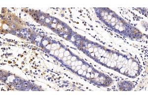 Detection of IL6 in Human Colon Tissue using Monoclonal Antibody to Interleukin 6 (IL6) (IL-6 antibody  (AA 29-212))