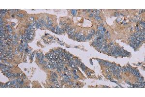 Immunohistochemistry of paraffin-embedded Human colon cancer using MMP20 Polyclonal Antibody at dilution of 1:40 (MMP20 antibody)