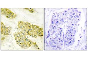 Immunohistochemistry analysis of paraffin-embedded human breast carcinoma tissue using COL5A3 antibody. (COL5A3 antibody  (N-Term))