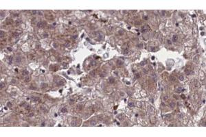 ABIN6273956 at 1/100 staining Human liver cancer tissue by IHC-P. (OR4C45 antibody)
