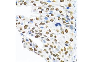 Immunohistochemistry of paraffin-embedded human prostate cancer using PTBP1 antibody at dilution of 1:100 (40x lens). (PTBP1 antibody)