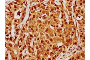 IHC image of nacHU diluted at 1:20 and staining in paraffin-embedded human liver cancer performed on a Leica BondTM system. (HIST1H4A antibody  (AA 74-85))