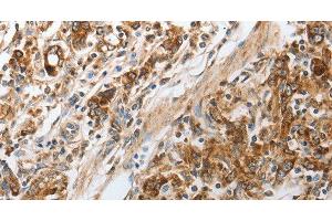 Immunohistochemistry of paraffin-embedded Human gastic cancer using NPY1R Polyclonal Antibody at dilution of 1:30 (NPY1R antibody)