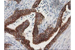 Immunohistochemical staining of paraffin-embedded Adenocarcinoma of Human colon tissue using anti-TUBB4 mouse monoclonal antibody. (TUBB4 antibody)