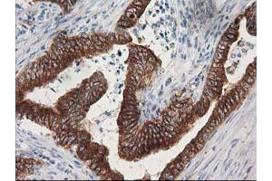 Immunohistochemical staining of paraffin-embedded Adenocarcinoma of Human colon tissue using anti-TUBB4 mouse monoclonal antibody.