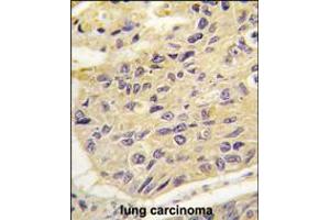 Formalin-fixed and paraffin-embedded human lung carcinoma tissue reacted with FRAT1 antibody , which was peroxidase-conjugated to the secondary antibody, followed by DAB staining. (FRAT1 antibody  (AA 99-128))